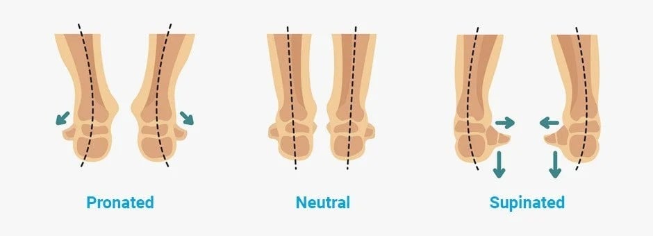 pronation types neutral vs overpronation vs supination
